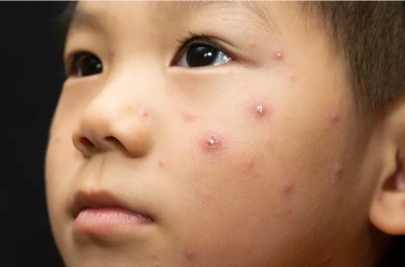 济南立和中医：孩子患上荨麻疹怎么办